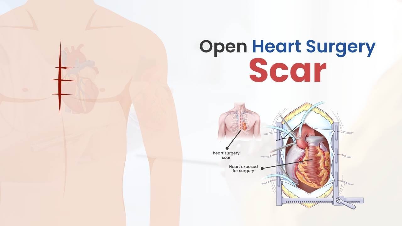 Open Heart Surgery Scar