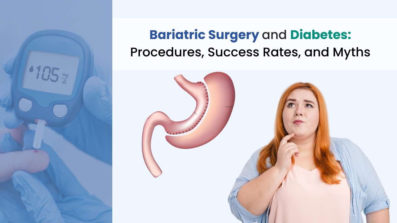 Bariatric Surgery and Diabetes: Procedures, Success Rates, and Myths