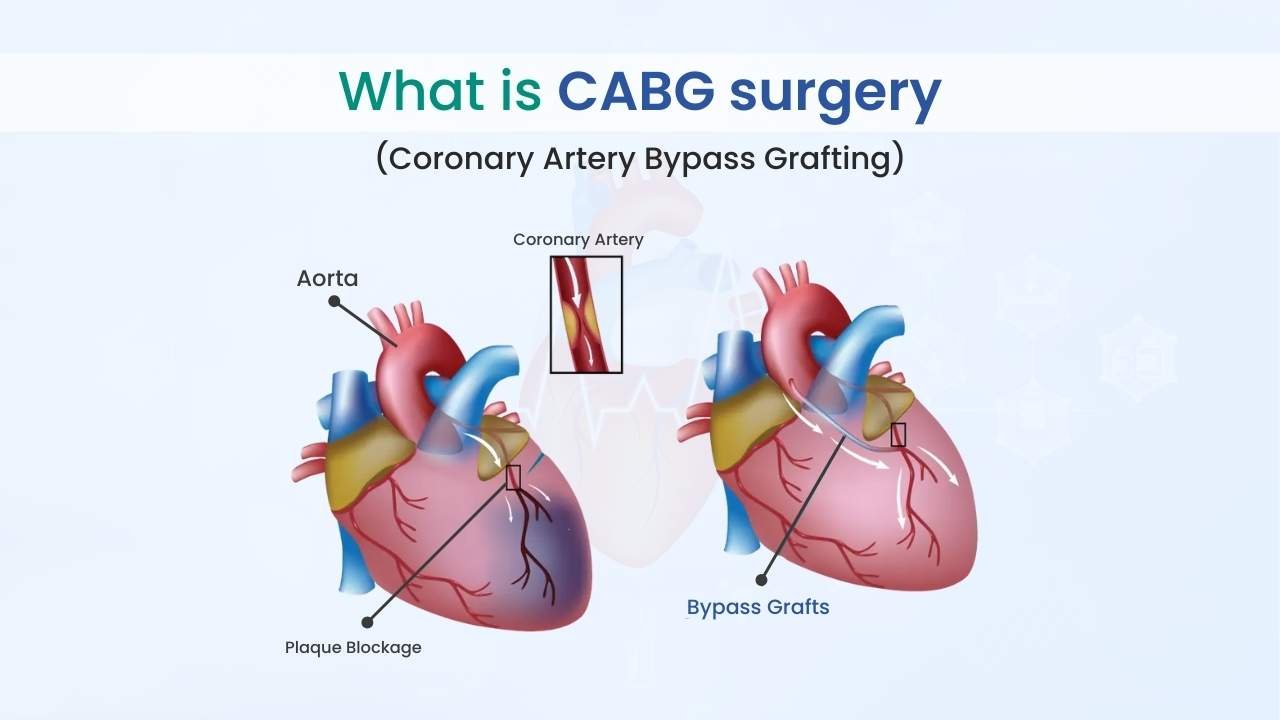 What is CABG surgery (Coronary Artery Bypass Grafting)