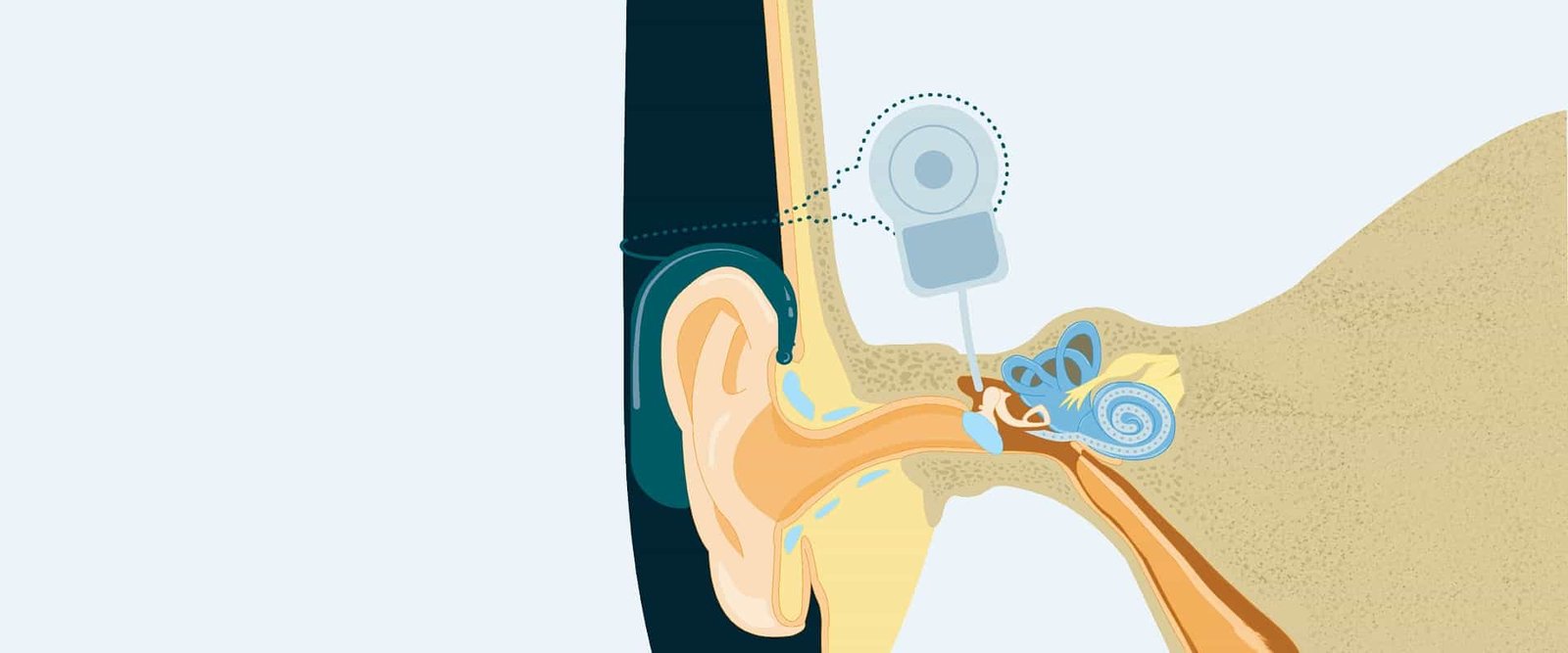 5 Conditions When You Should Consider a Cochlear Implant