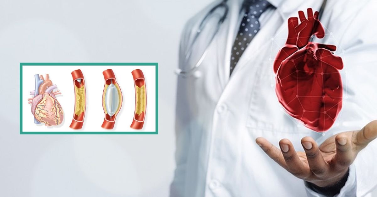 5 Conditions When You Should Consider Balloon Angioplasty