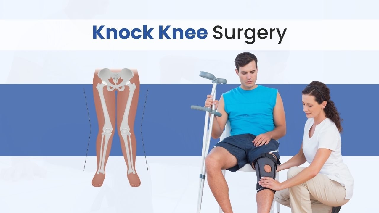 Knock Knee Surgery